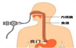 消化道出血早期的症状，脓血便和粘液血便图片